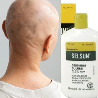 Une tête chauve et flacon soufre de sélénium supérieur "SELSUN" sulfure de sélénium.