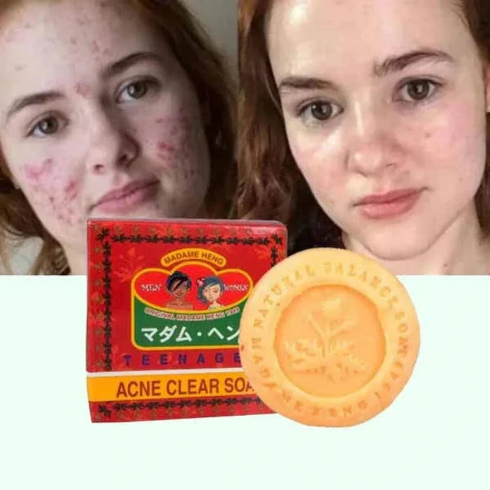 Madame Heng, tvål för aknebehandling, 150 g för tonåringar, tonåringar, män och kvinnor, produkt från Thailand