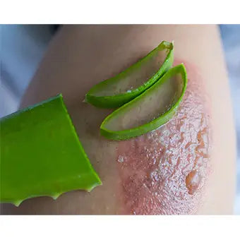 aloe vera soigne les cicatrices et les brulures