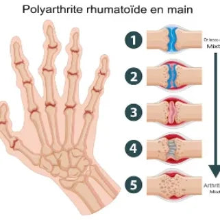  Illustration d'une main souffrant de polyarthrite humérale, avec des antidouleurs Tamalou Siang Pure pour apaiser l'arthrite