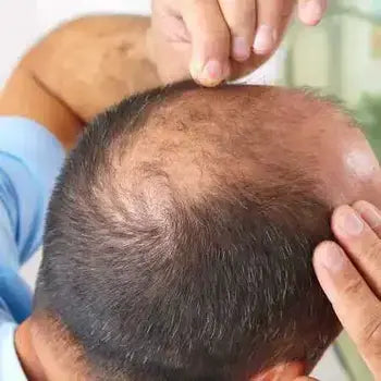 Homme inspectant sa calvitie avec perte de cheveux prononcée