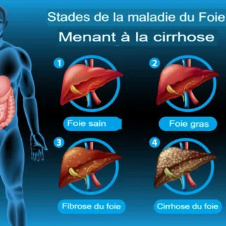 Représentation des phases de la maladie humain, intégrant les clous de girofle, favorables à la santé hépatique