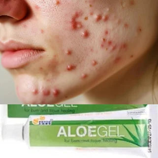 Peau irritée, gel d'aloe vera, remède naturel pour apaiser les irritations.