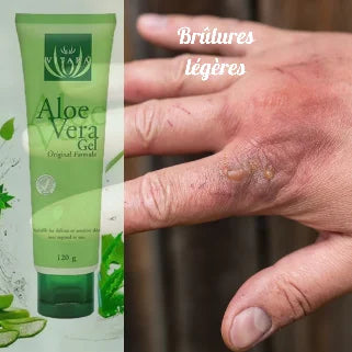  Brûlure légère sur une main et un tube de gel d'aloe vera