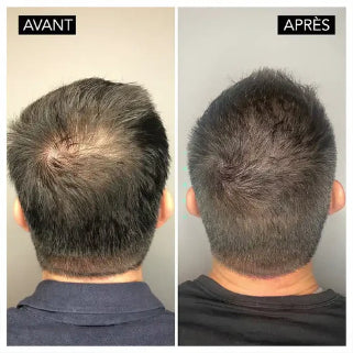 Comparaison du traitement avant et après, montrant une repousse de cheveux.