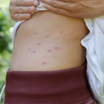 piqures de moustiques sur le ventre