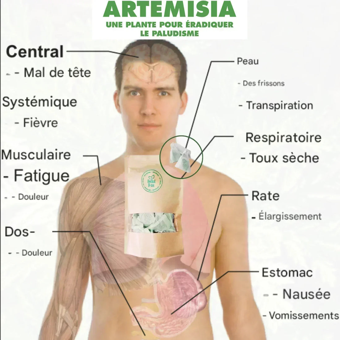 homme avec effets du paludisme, zones affectées, et produit Artemisia annua contre la maladie.