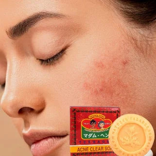 une personne avec des imperfections cutanées et une boîte de savon et un savon contre l'acné posés à côté