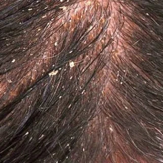 L'image montre de près des cheveux recouverts de pellicules