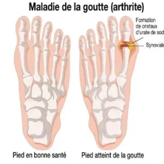 Illustration de l'arthrite goutteuse, soulignant le Tappe Tea, un allié naturel pour combattre les crises de goutte