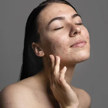 Une femme touchant son visage avec de l'acné, yeux fermés