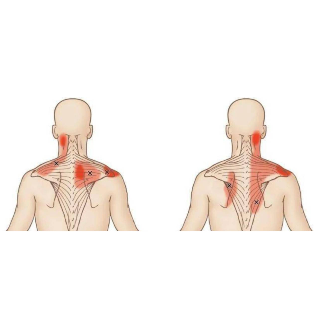 Tensions à la Nuque et aux Épaules