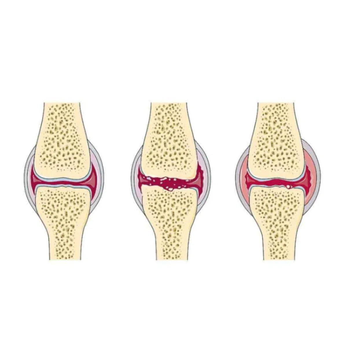 Douleurs Articulaires et Arthrite