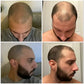 Neo Hair Lotion Tonic - Anti Perte des Cheveux convient hommes et femmes